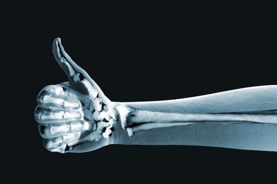 X-rays to diagnose finger joint pain