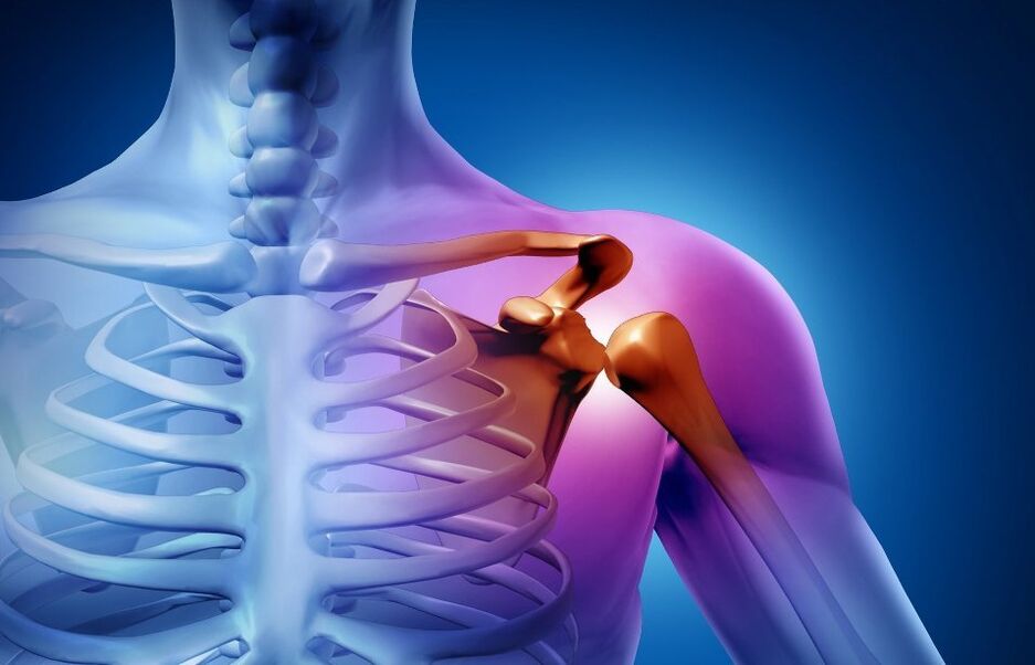Injury to the shoulder joint due to arthrosis