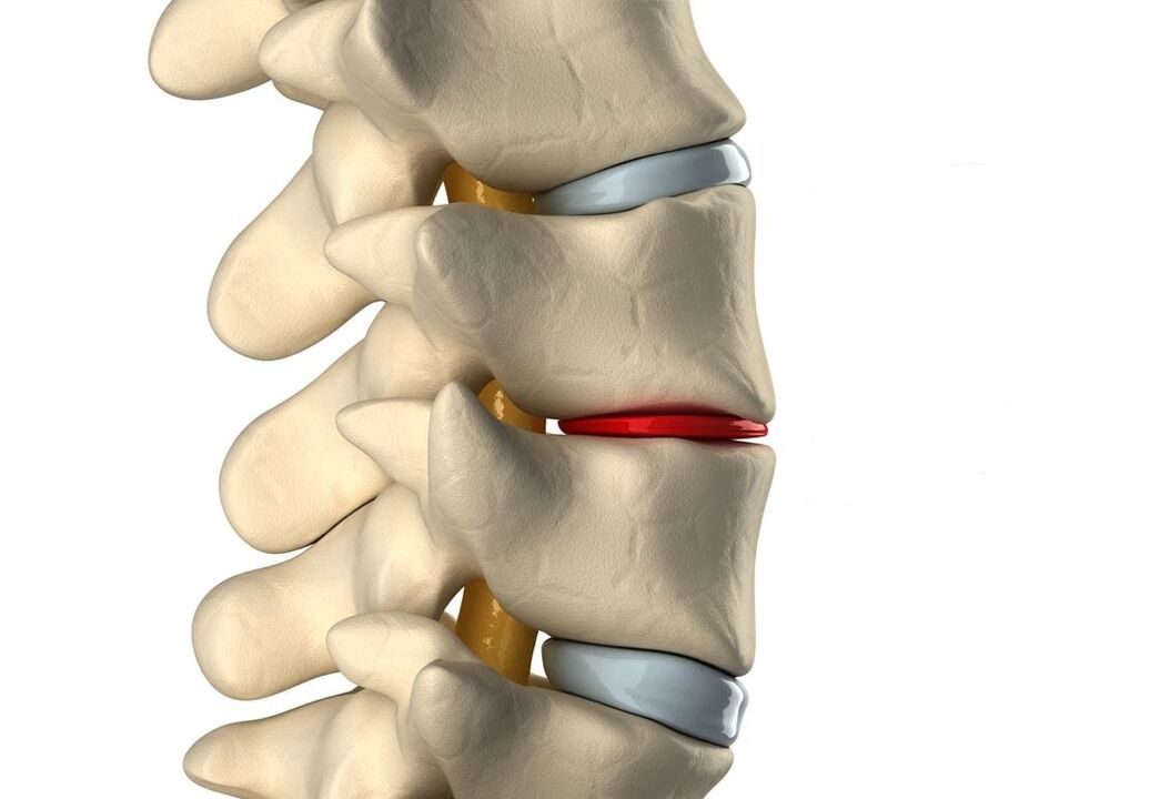 Healthy intervertebral disc (blue) and damaged (red) due to thoracic osteochondrosis