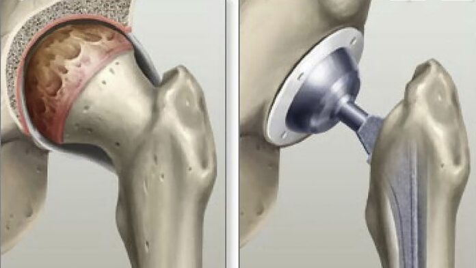 Hip replacement is performed in the late stages of coxarthrosis