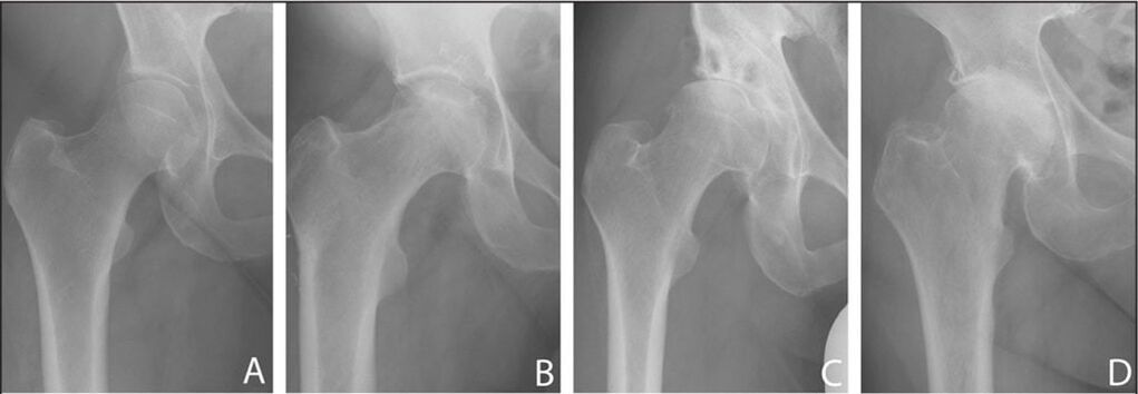 Stages of development of arthrosis of the hip joint on X-ray