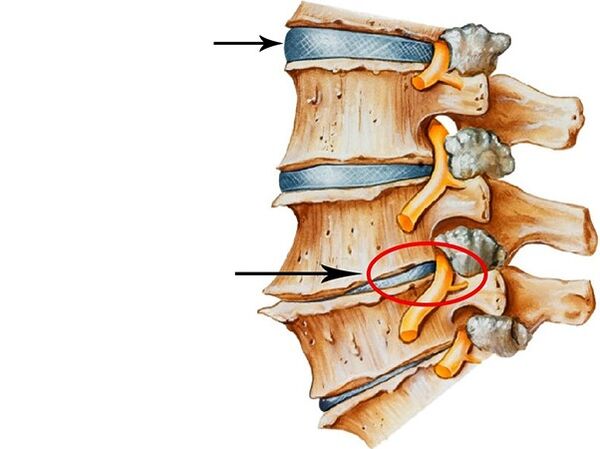 Intervertebral disc disorder