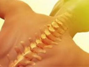 Ostiochondrosis - Spinal disease