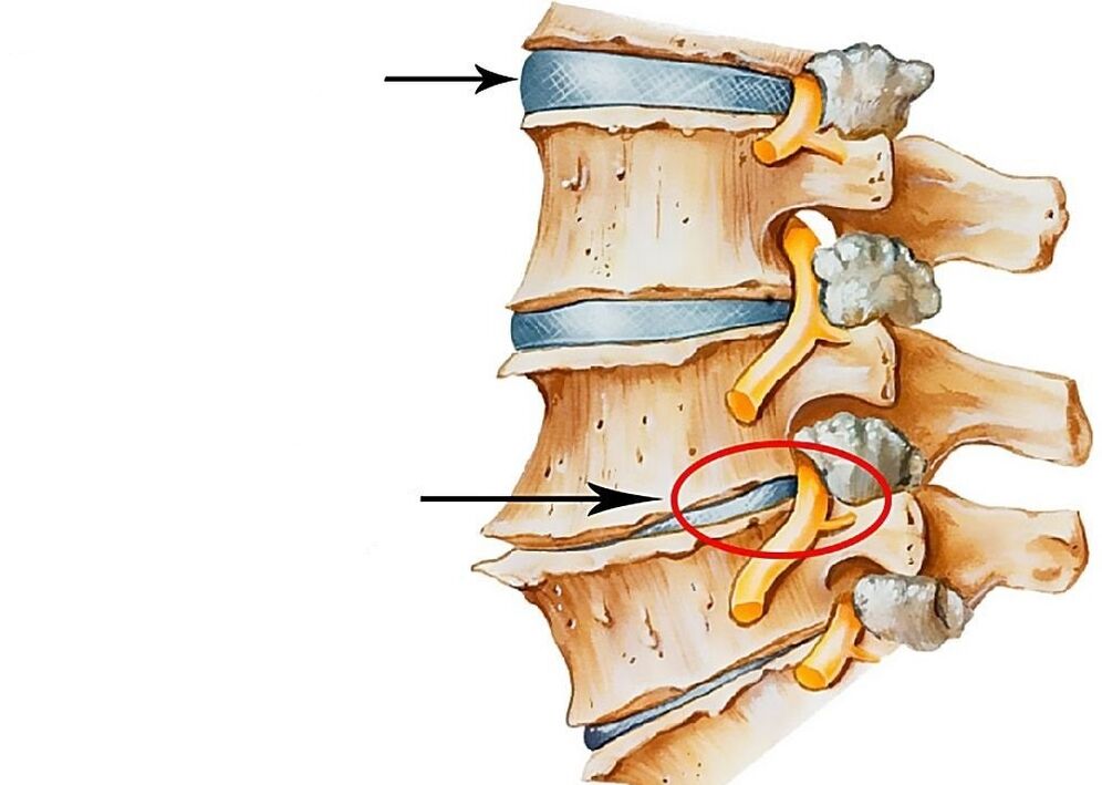 Illustration of healthy and deformed spinal discs