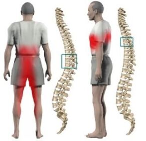 spinal bulge