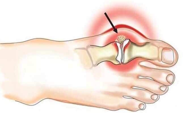 Swelling of the joint between the big toe and the middle of the foot due to arthritis