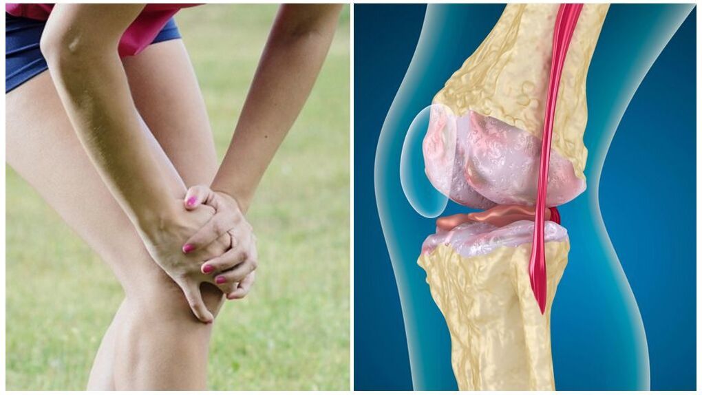 Symptoms of arthrosis