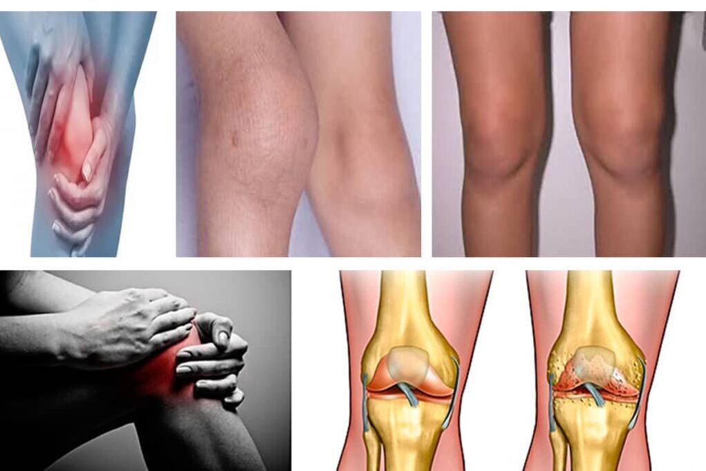 arthrosis what is it