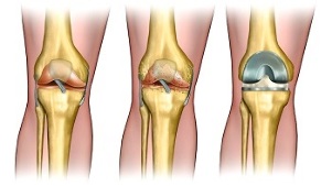 Endoprosthetics for arthrosis of the knee joint